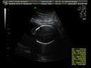 Ultrasound 19 Weeks Ultrasound 19 Weeks