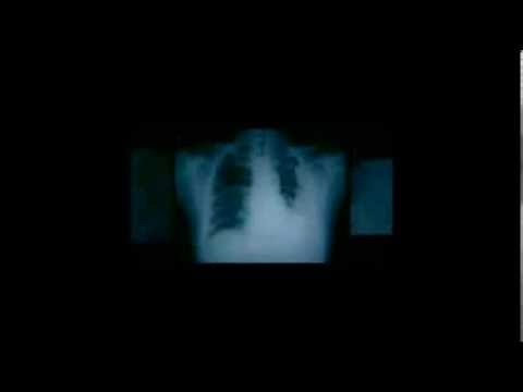 Crucial thing with mesothelioma law firm Mesothelioma Your | Best | Top Mesothelioma law firm