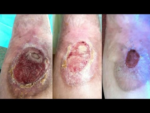 how to cure skin infection