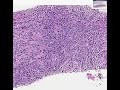 Histopathology Pre-sacral mass --Diffuse large B-cell lympho