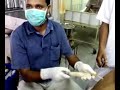 Tapping of recurrent pleural effusion - Dr Sanuudayan