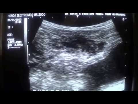 how to locate placenta on ultrasound