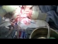 Operasi Bypass Jantung.mp4