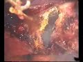 laparoscopic total hysterectomy and bilateral adnexectomy