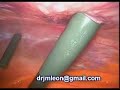 sleeve gastrectomy by dr. Jesse Leon sleeve gastrectomy by dr. Jesse Leon
