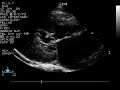 Systolic anterior motion (SAM) of the mitral valve in a cat with severe hypertrophic cardiomyopathy (HCM)