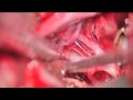 Clipping a basilar tip aneurysm