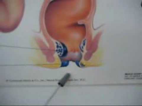 Dr. B and Hemorrhoids