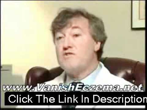 how to cure dyshidrosis