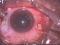 Vitreous Haem due to CNVR Vitrectomy + Membrane Peel.flv