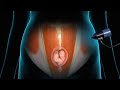 Laparoscopic Ventral Hernia