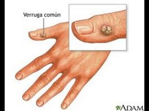 how to cure un ojo de pescado
