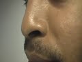 The Acne Practice  (Redness and Facial Flushing 1)