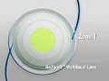 Rezoom Multifocal lens after Catracat Surgery Rezoom Multifocal lens after Catracat Surgery