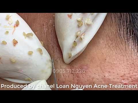 Extractions_Loại bỏ mụn đầu đen nổi bật nhất | Loan Nguyen