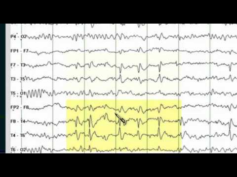 abnormalities - Review of physiological and pathological focal EEG findings.