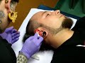 Dermal Punch 11mm by John Durante/ www.propiercing.cl Dermal Punch 11mm by John Durante/ www.propiercing.cl