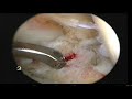 Knee OP