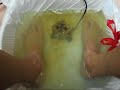 Foot Detox helps IBS? Day 3 Foot Detox helps IBS? Day 3