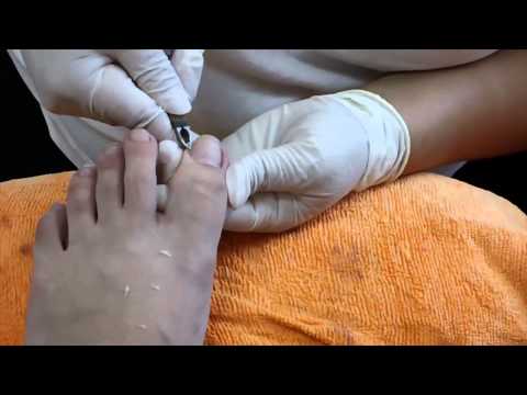 how to dissolve your toenail