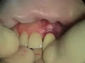 Transition to Implant, Failing Upper Central