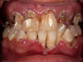 Meth Mouth Video - The Effects of Methamphetamines on Teeth Amphetamine and Dextroamphetamine