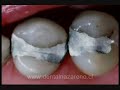 Corona Dental-Caries