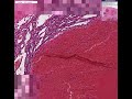 Histopathology Breast, soft tissue--Hemangioma