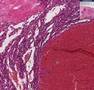 Histopathology Breast, soft tissue--Hemangioma