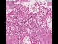 Histopathology Lung--Diffuse alveolar damage (adult respirat Histopathology Lung--Diffuse alveolar damage (adult respirat