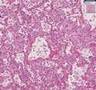 Histopathology Lung--Diffuse alveolar damage (adult respirat