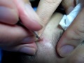pimple picking 2