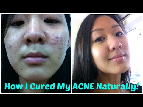 how to cure an acne fast