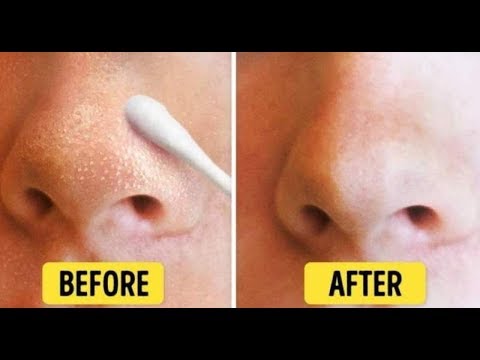 how to get rid whiteheads on nose