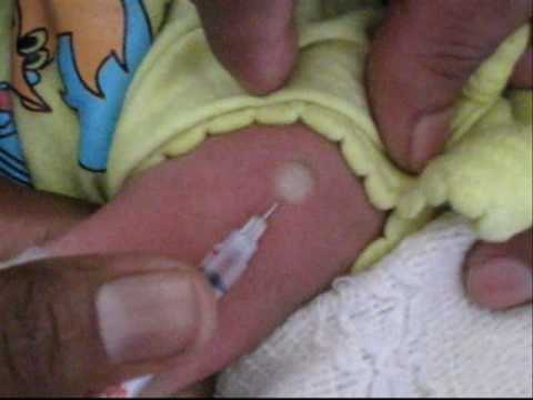 how to administer ppd