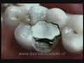 Caries-Corona Dental