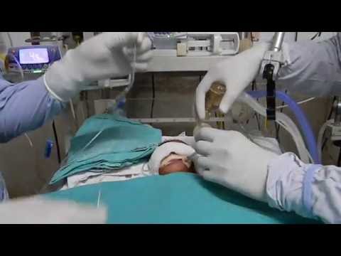 how to administer surfactant