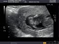 baby moving on scan