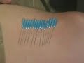 500 Needles in Eric 500 Needles in Eric