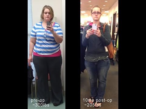 3 Month Weight Loss Gastric Sleeve