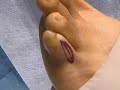 Cosmetic Foot Surgery - Women