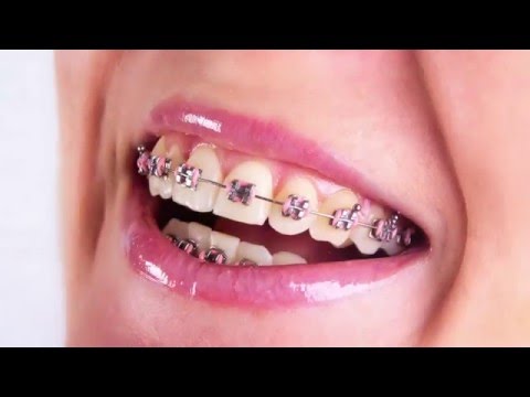 brackets invisibles precio brackets invisibles precio