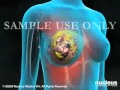 Breast Cancer Sugery How to Prevent