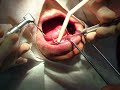 Confecção dos alvéolos para posterior instalação dos implantes