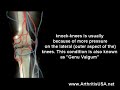 Knee pain due to knock knees by dr Farshchian