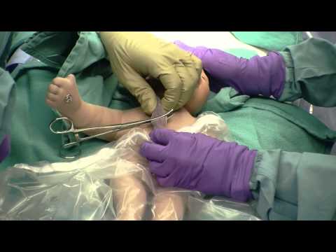 how to remove umbilical cord clamp