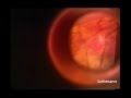 videos de Laser Suture Lysis (LSL) after Trabeculectomy