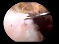 rotator cuff tear subacromial decompression rotator cuff tear subacromial decompression