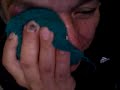 Dads pimple