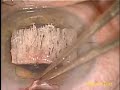 Trabeculectomy Right eye after Temporal Cataract Extraction